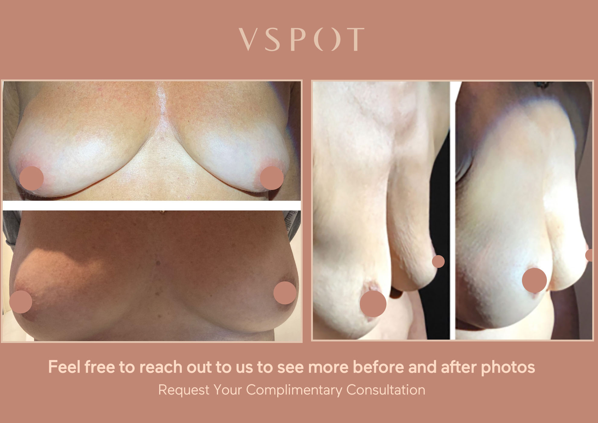 Vampire-Breast-Lift-Vspot-before-and-after-photo