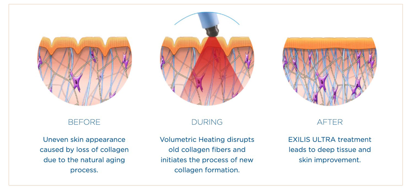 ADVANTAGES AND BENEFITS OF SKIN TIGHTENING NEAR ME IN MIAMI Skin tightening procedures near me